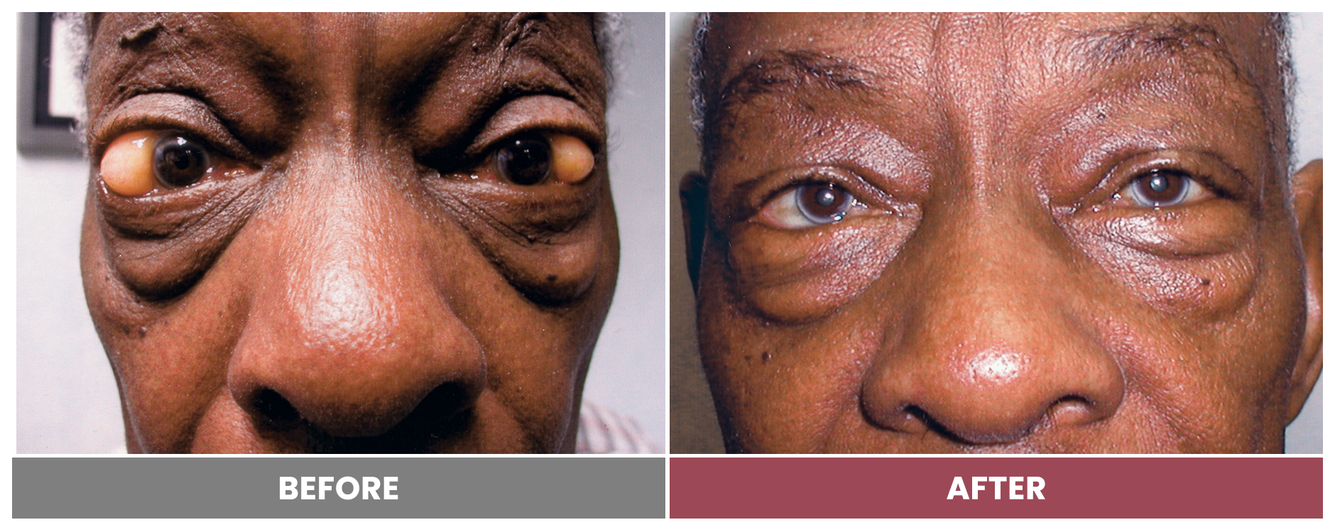 TUMOR REMOVAL AND RECONSTRUCTION - Case 8